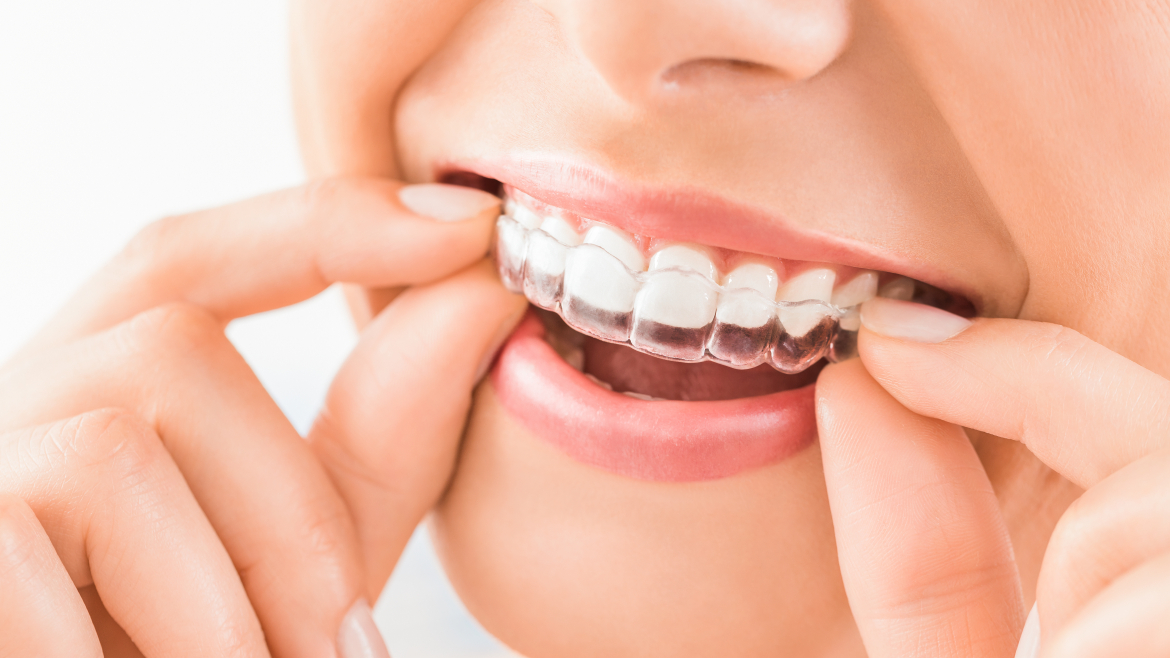 How Do I Take Care of My Invisalign?